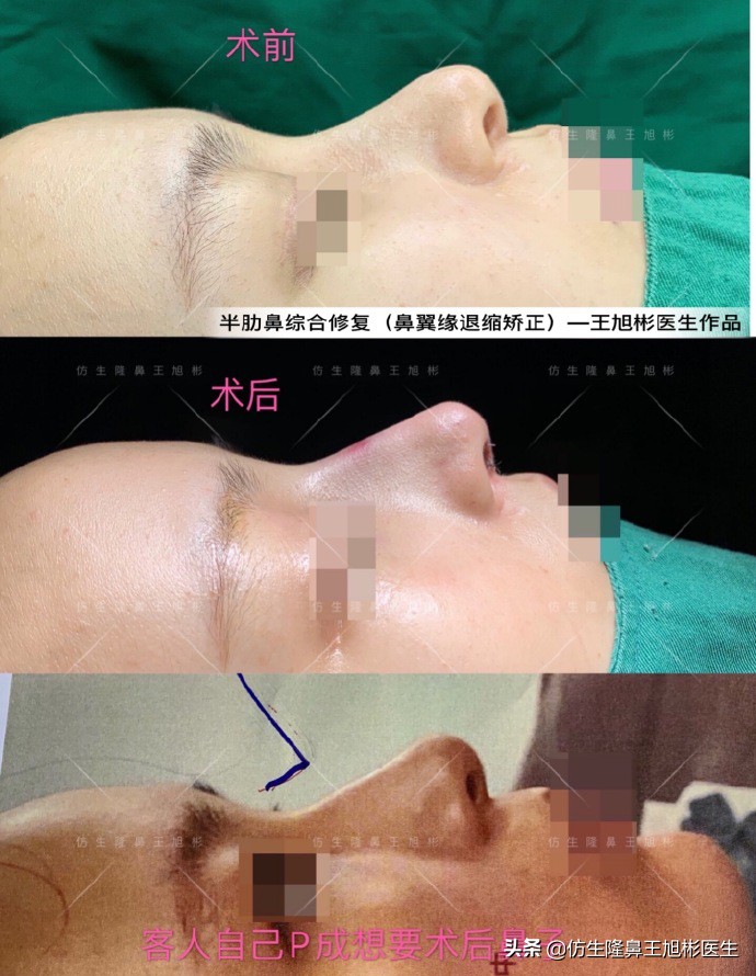 隆鼻的鼻翼怎么修复,隆鼻后多久可以做鼻翼缘矫正