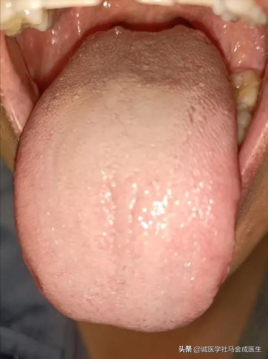 麻疹鉴别视频,荨麻疹寒热怎么治疗