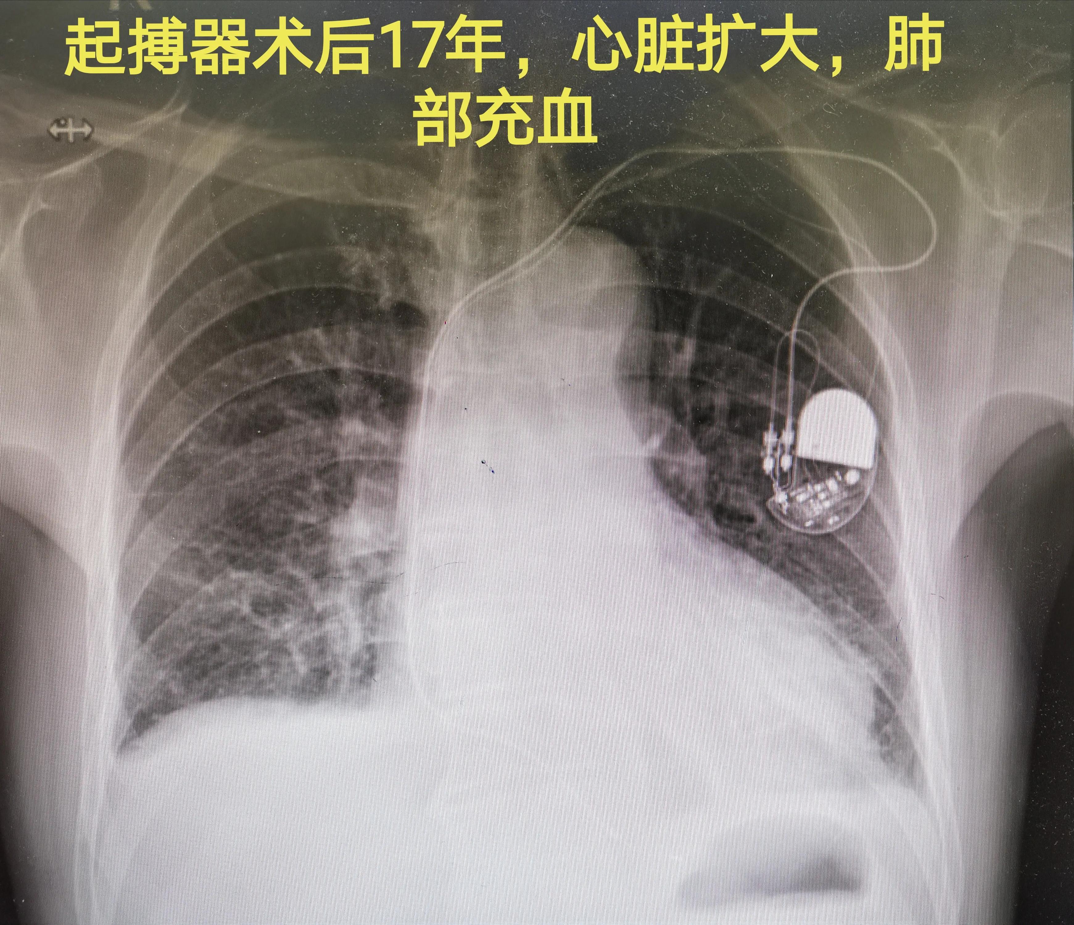 88岁老人心跳过快需要装起搏器吗,老人胸闷气短找中医看可以吗