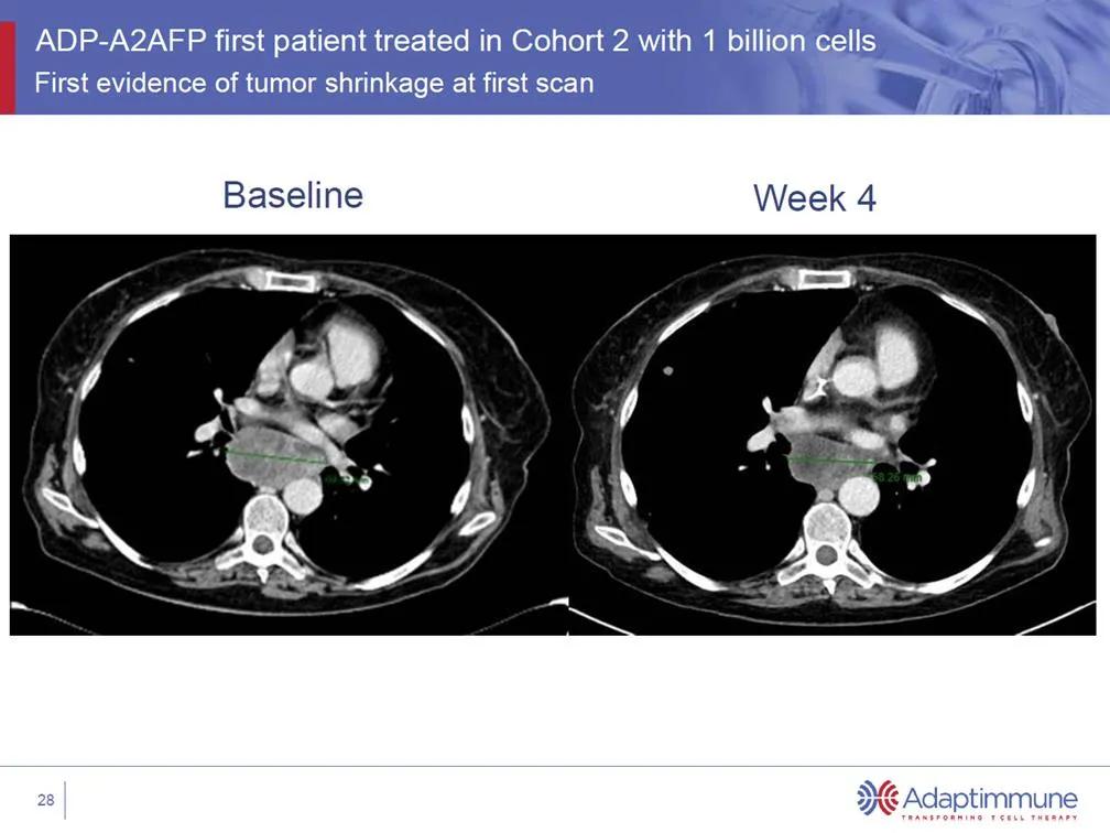 肝癌晚期最新突破药,t细胞治肝癌最新临床进展