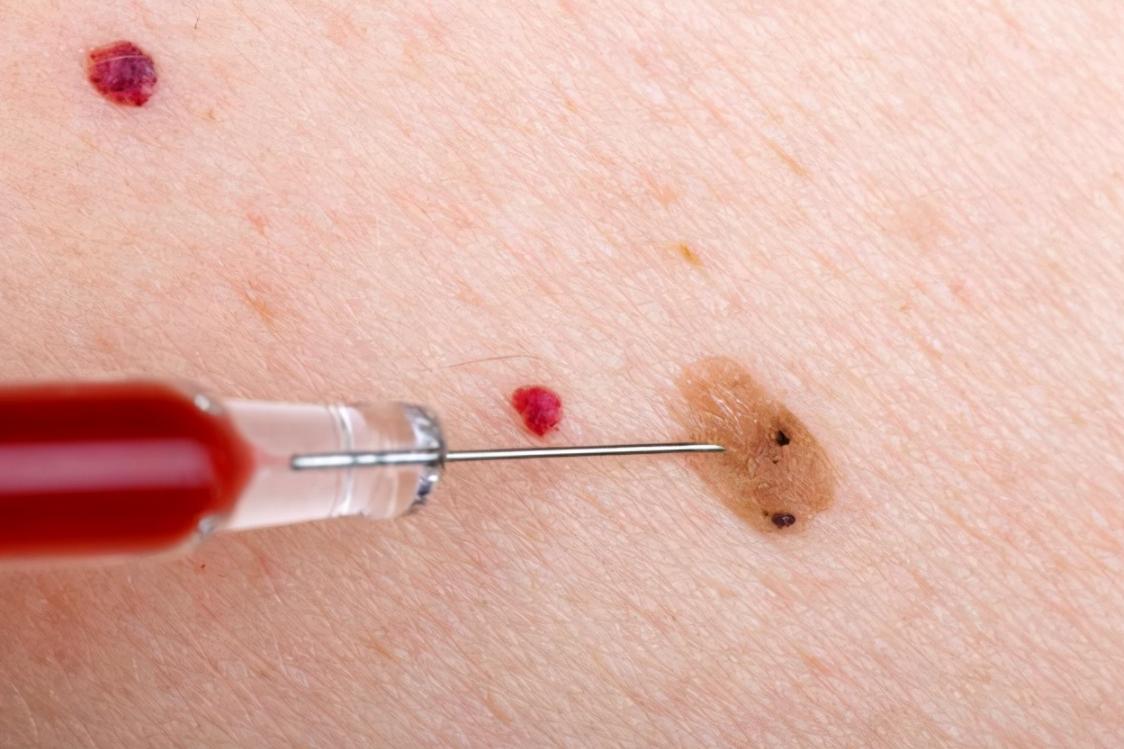 身上的痣自己会消除吗,身上的痣能随便去掉会死吗