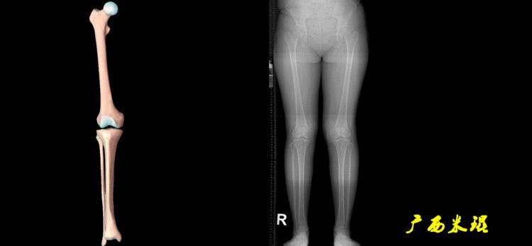 广西骨科医生米琨最新信息,米琨广西骨科什么水平