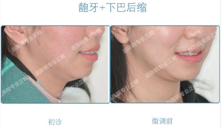 杭州成人隐形矫正牙齿优惠,矫正牙齿杭州无创伤