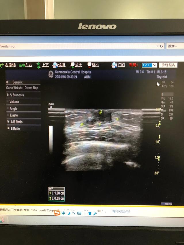 儿童性早熟要做哪些检查？怎么根据这些指标判断真性还是假性？