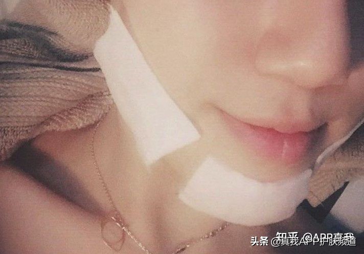 刷酸爆闭口要不要继续刷,刷酸祛闭口几天能有效果