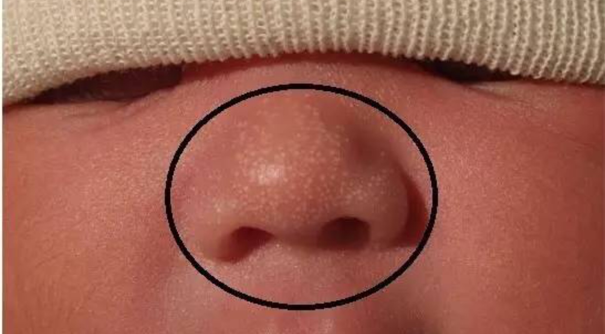 宝宝脂溢性湿疹可以涂什么药膏,宝宝湿疹脂溢性皮炎