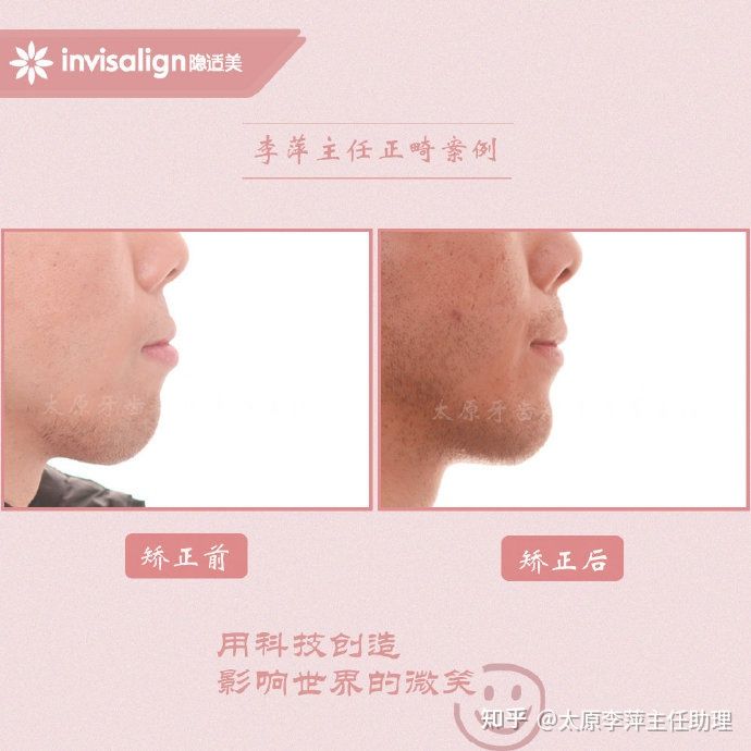 太原牙齿矫正靠谱吗,太原成人隐形牙套牙齿不齐