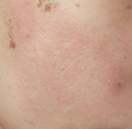 点阵激光能把伤疤完全修复吗,激光点阵可以修复到多少程度