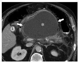简述急性胰腺炎影像学表现,有关急性胰腺炎疼痛的图片
