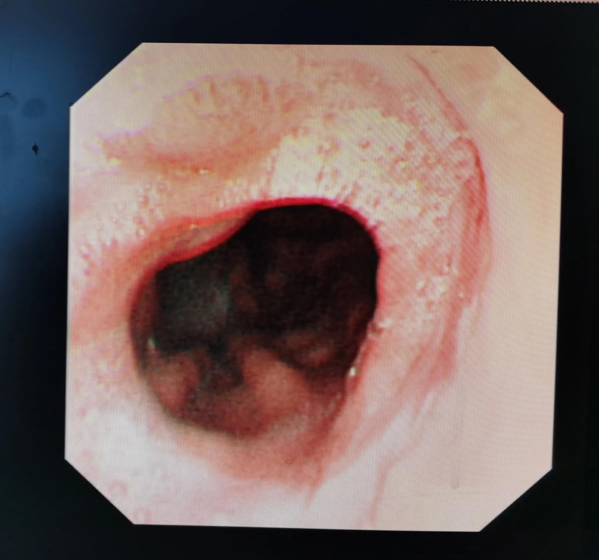 贲门癌吐血抢救,中国最著名的贲门癌治疗专家