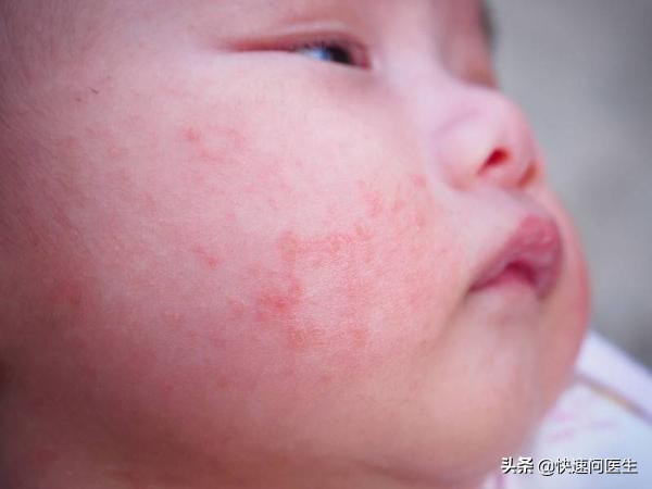 宝宝长湿疹抹炉甘石洗剂还更严重,宝宝长湿疹用药擦对身体有影响吗