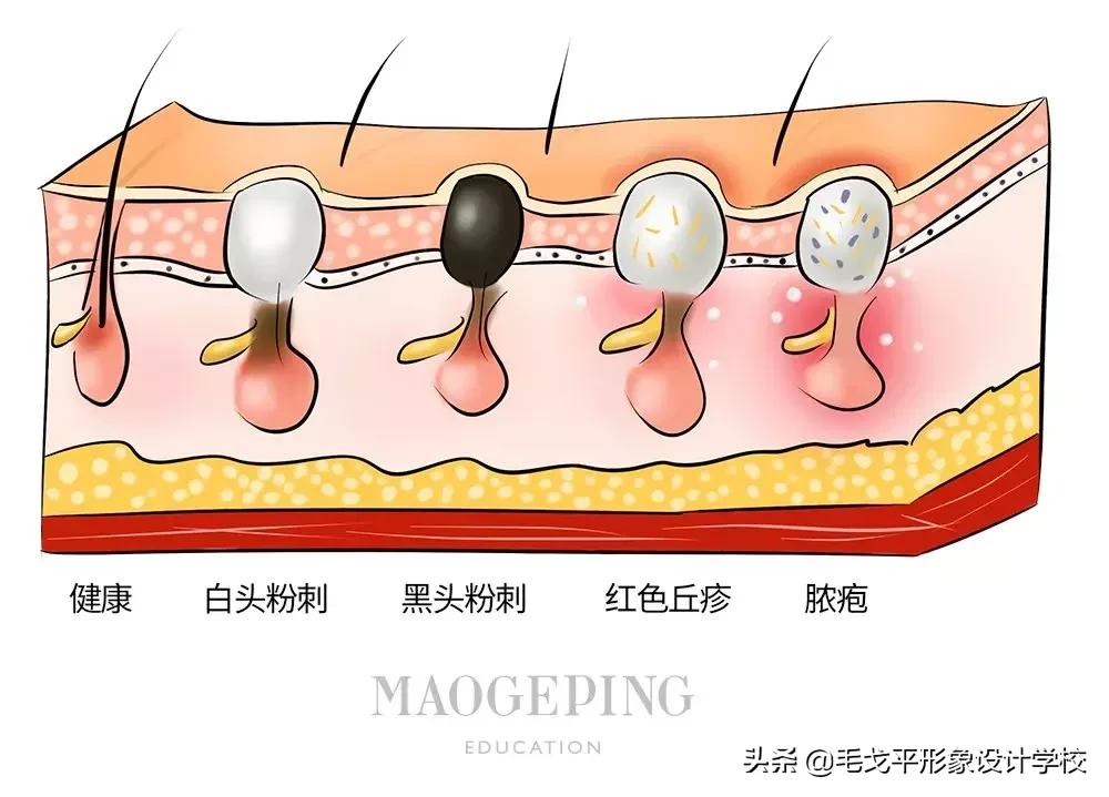 有黑头又泛红的草莓鼻怎么办,毛孔粗大草莓鼻清理黑头