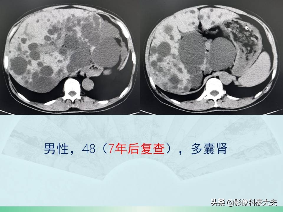 得了尿毒症又得了癌症怎么办,尿毒症为什么发病大多是年轻人呢
