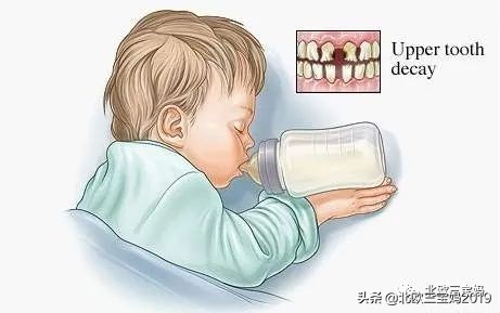 3岁儿童全麻做根管有影响吗,宝宝捆绑治疗蛀牙