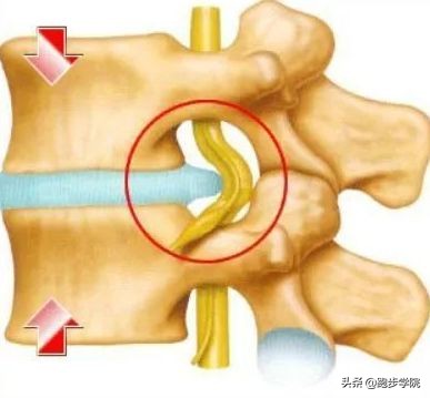 腰椎间盘突出跑步好还是跳绳好,腰椎间盘4-5节突出可以跑步吗