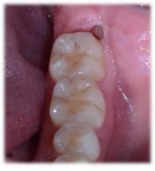 智齿有蛀牙但不痛需要拔掉吗,牙医讲述智齿到底要不要拔