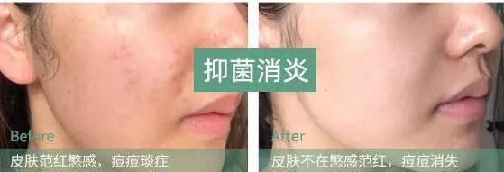 张韶涵澳洲玲珑面膜,张韶涵护肤敏感肌