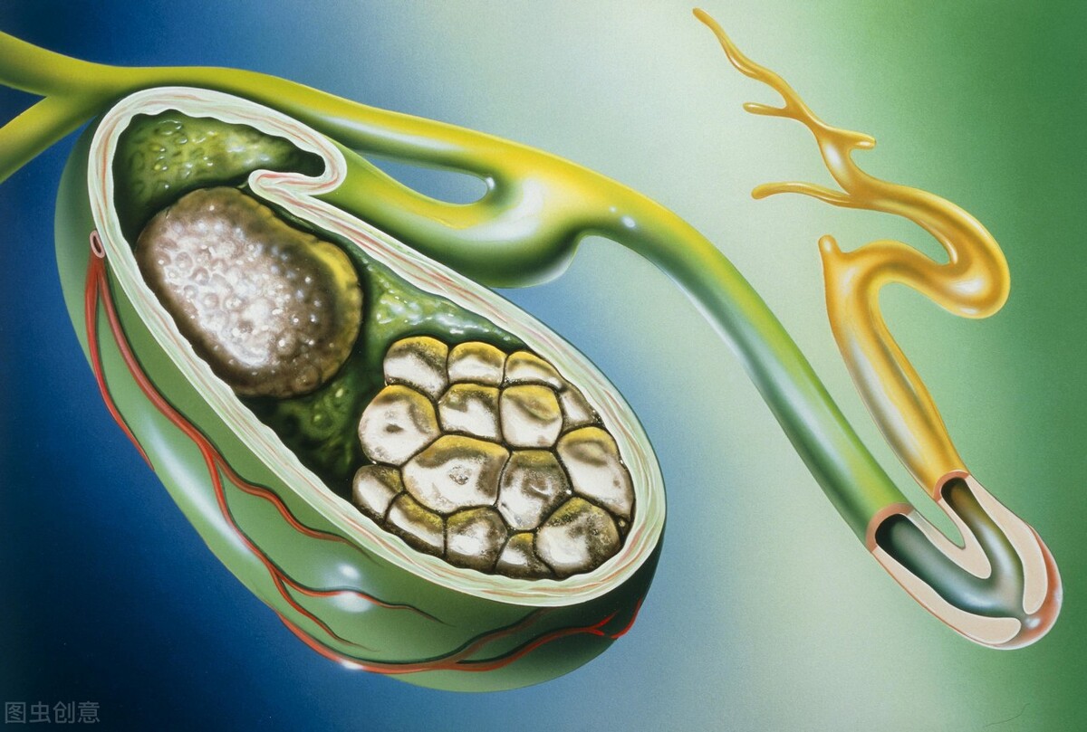 胆囊结石24mmx18mm需要做手术吗,得了胆囊结石该怎么办