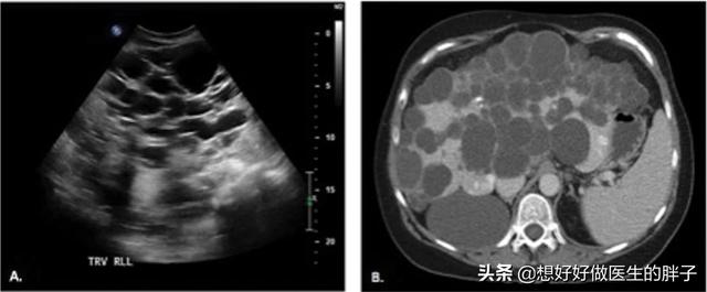 辟谣囊肿手术,如果囊肿是良性的话要不要做手术