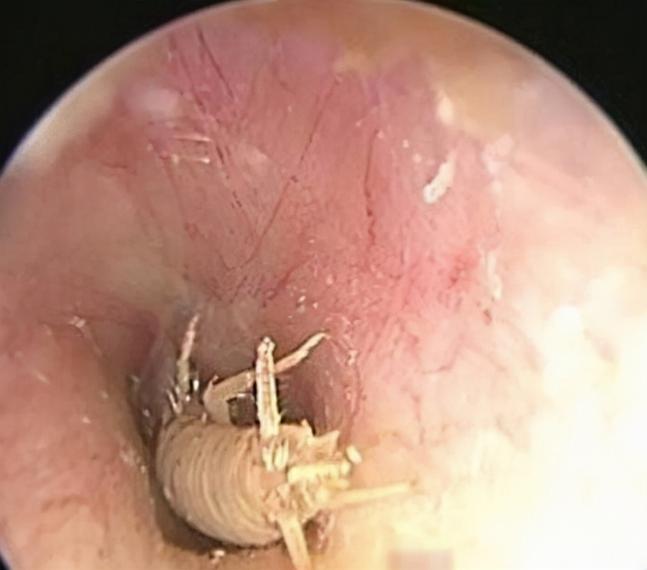 女子网购衣服被赠蟑螂,一女子购买冬装出现蟑螂卵