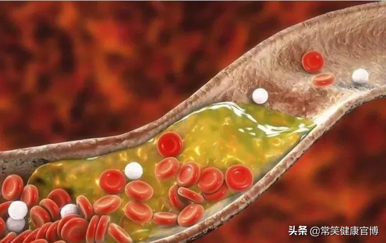 得了高胆固醇血症怎么办,高胆固醇血症有五个表现症状