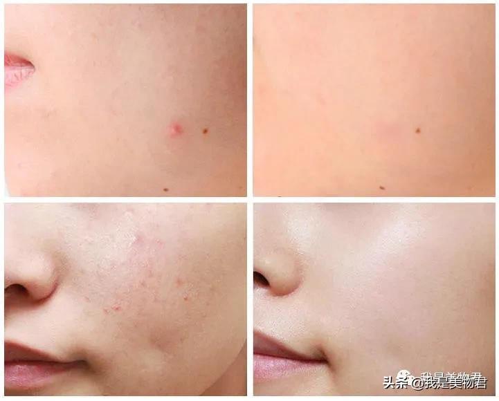 敏感肌最好的祛闭口神器,去闭口的最佳方法敏感肌