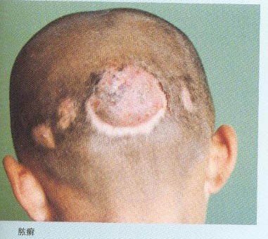 远离真菌,验方治愈一切真菌感染皮肤病