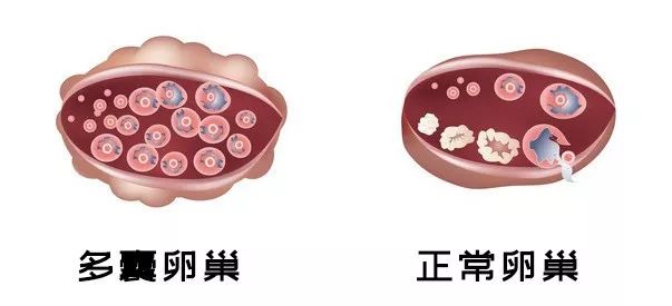 b超显示多囊闭经是多囊综合征吗,b超显示卵巢多囊样改变