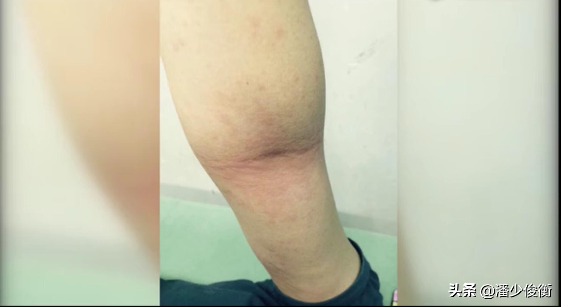 红火蚁被咬后会有什么情况,危险物种入侵红蚁