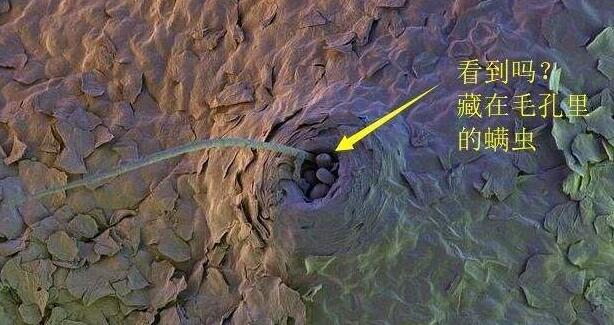 脸部螨虫多毛孔粗大,脸上螨虫毛孔粗大还能不能恢复