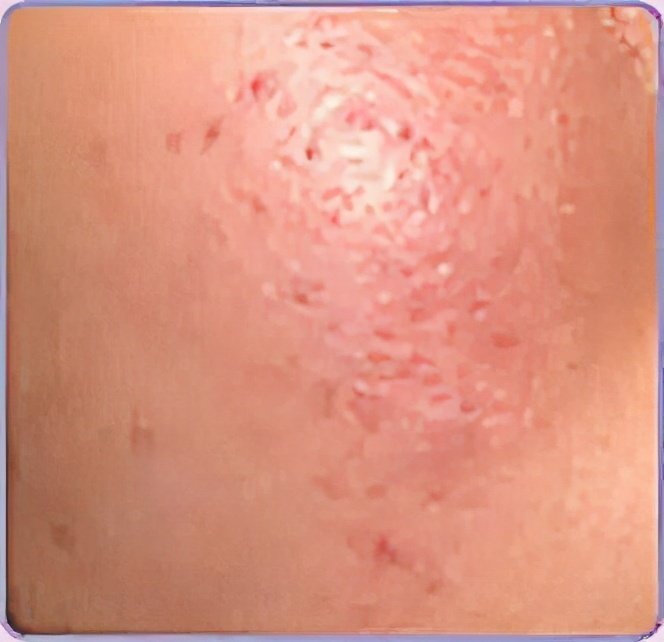 脸泛红是敏感肌还是过敏怎么判断,脸部敏感肌过敏是什么样的