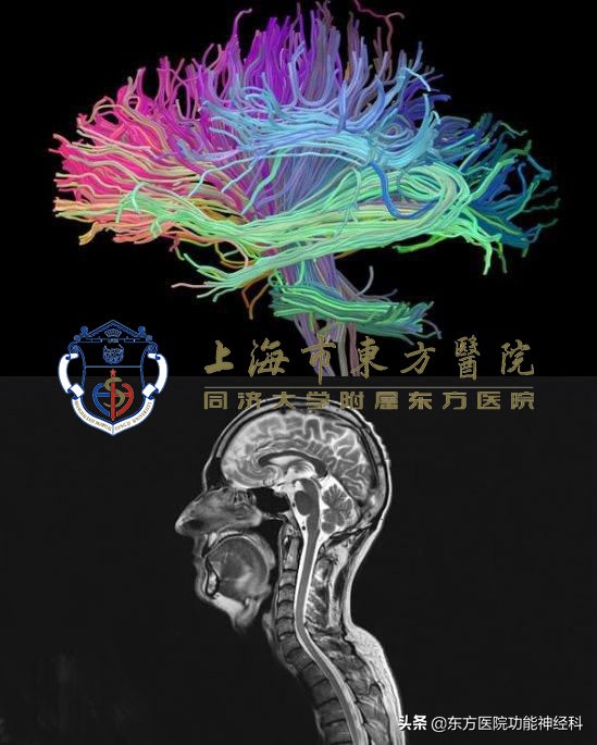 精神分裂症最新治疗药物,精神分裂症不治疗会怎样