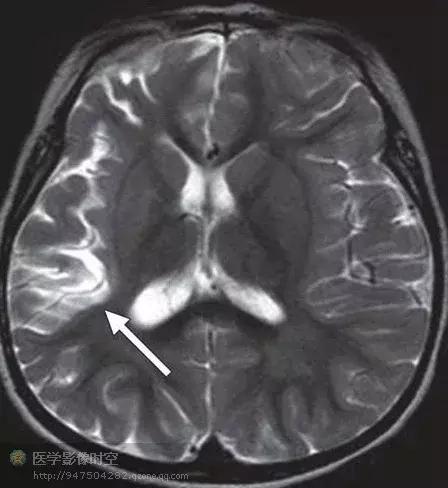 儿童癫痫CT表现,儿童各类癫痫脑电图特征