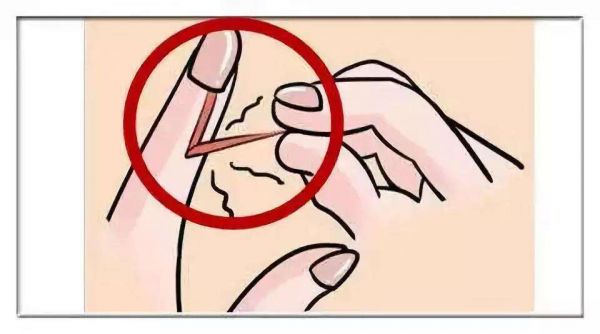 硬拔手上倒刺死亡案例,手撕倒刺导致坏死