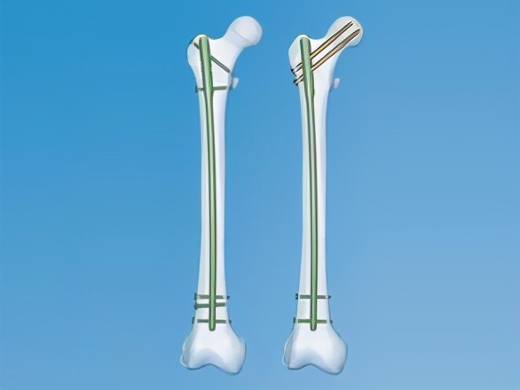 骨折上的钉还用取出来吗,骨折放的钢板是铁的吗