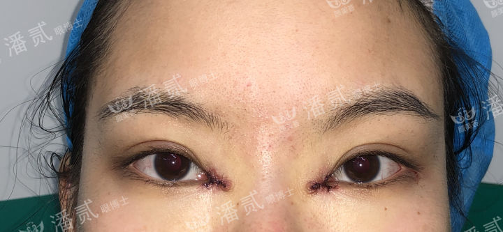 女孩眼部整形失败,内眼角整形失败