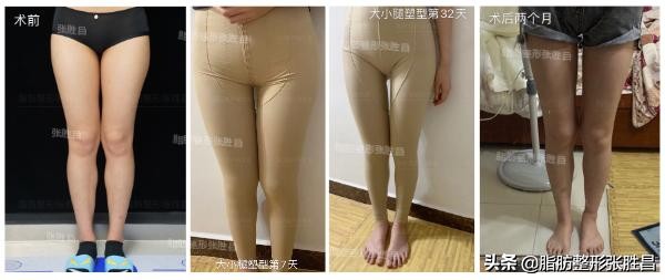 大小腿吸脂后走路,大小腿吸脂可以修饰腿型吗