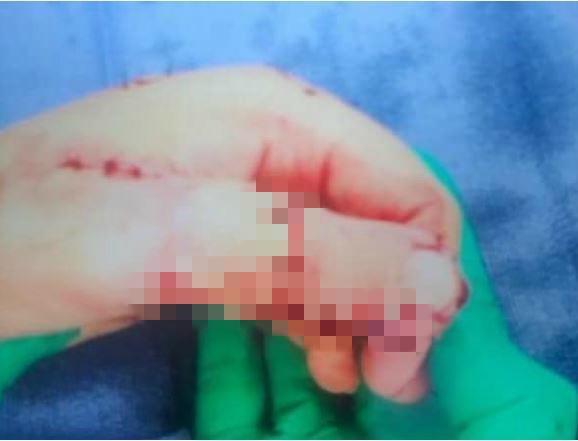 护士忘记取下止血带,护士忘记取止血带三个小时