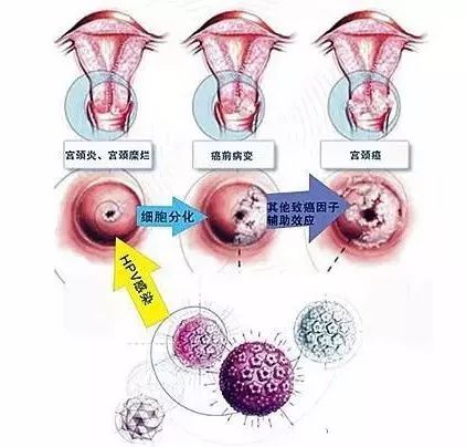 不想做检查，能测出早期宫颈癌吗？