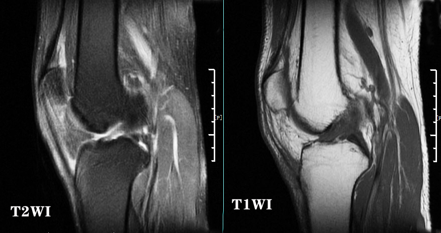 膝关节核磁共振报告单上怎么看,膝关节核磁正常报告单