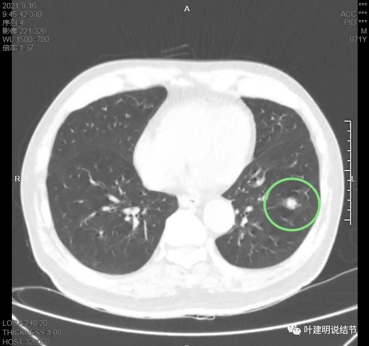 肺上有实性结节6mmx5mm是什么原因,肺上有1.7x1.8的实性结节该怎么办