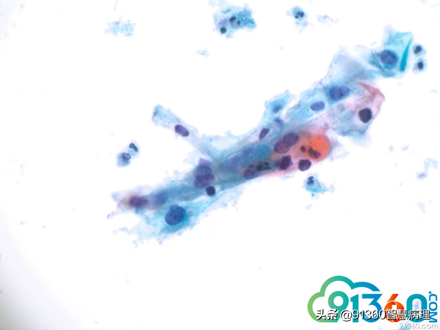 宫颈病理tct是什么检查,tct出现ascus会是宫颈癌吗