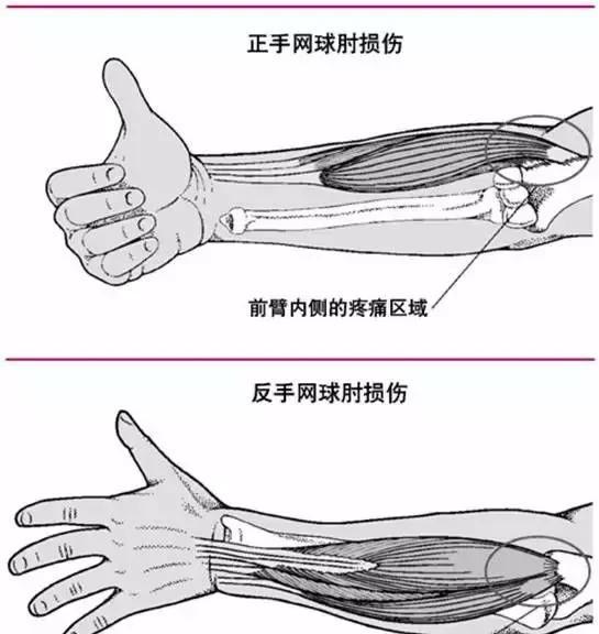 钓鱼人难免有磕磕碰碰,钓鱼保护肘关节