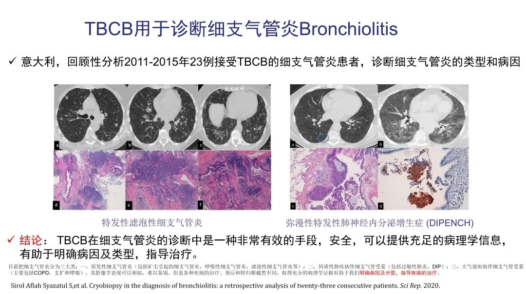 经皮肺穿刺活检术过程,经支气管冷冻肺活检