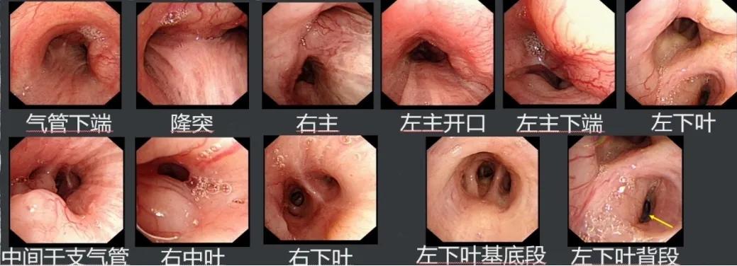 咳嗽咳痰胸腔积液10月余治疗无效，艰难追踪得出哪些教训？（上）