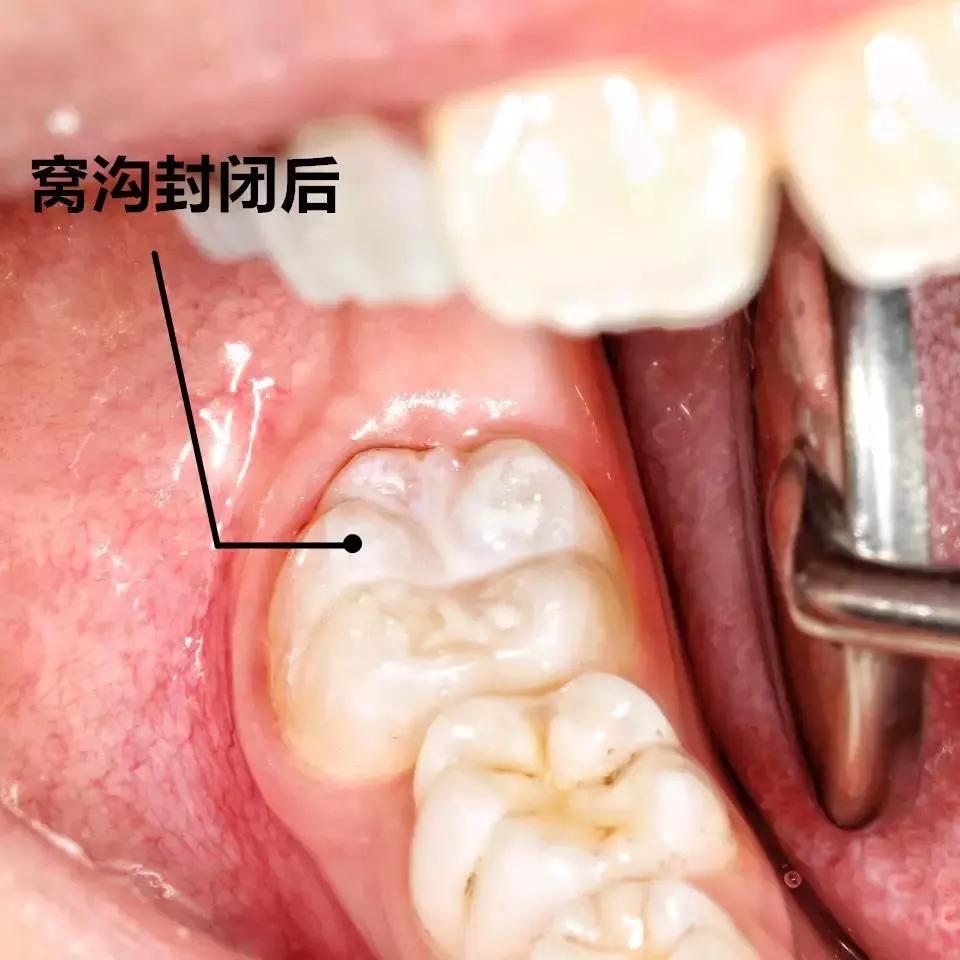 预防儿童蛀牙可打针预防吗,预防蛀牙可做窝沟封闭