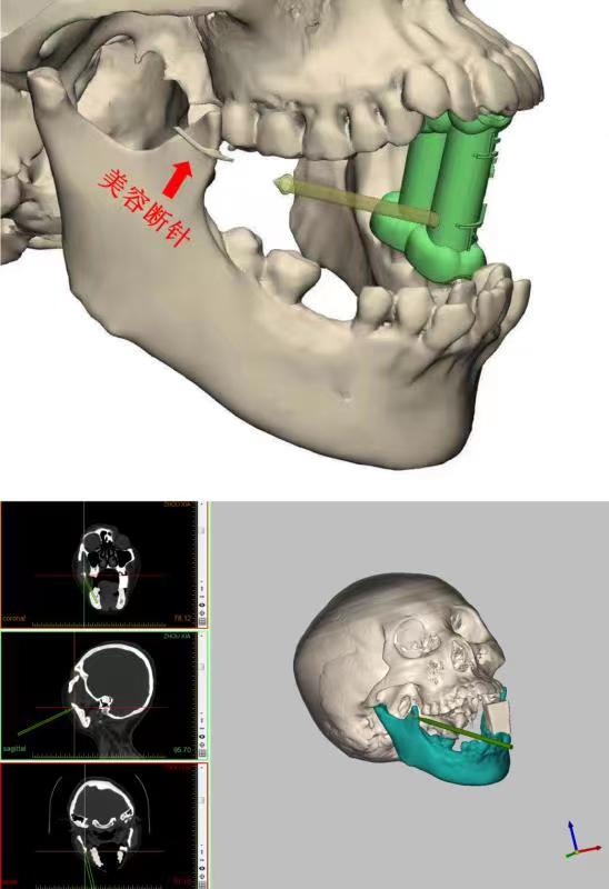 女子注射美容针,女子注射美容针后续