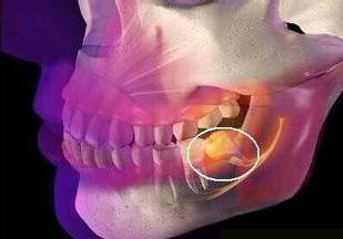 智齿冠周炎治疗方法的全过程,智齿不能萌出导致牙龈肿痛怎么办