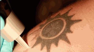 纹身激光去除后可以参军吗,激光去除纹身疤痕可以当兵吗