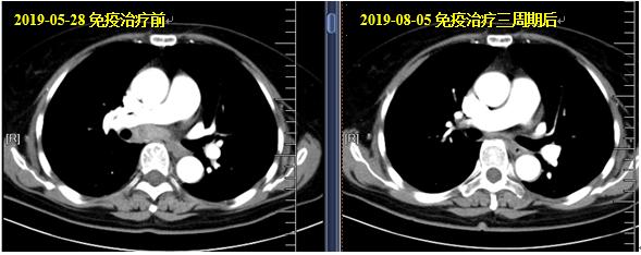 宫颈鳞状细胞癌抗原1.6,宫颈鳞状细胞癌抗原1.8确诊宫颈癌